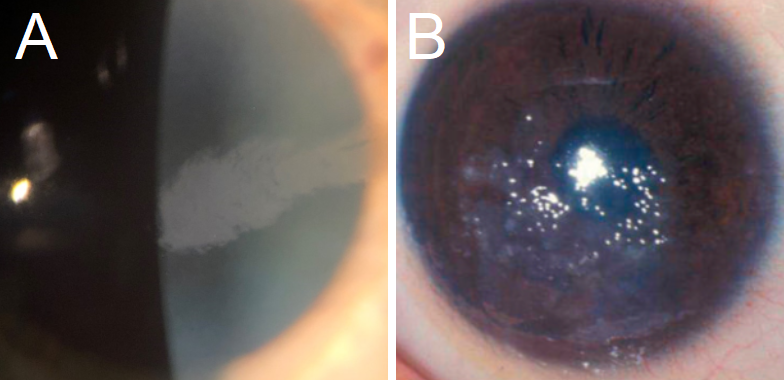 A: A typical presentation of a feather-shaped opacity often found in Lisch Corneal Dystrophy