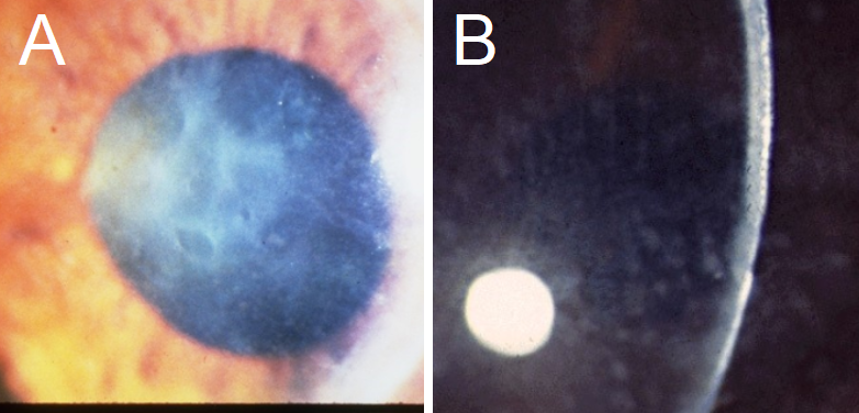 A: Reis-Bucklers Corneal Dystrophy presents with erosions and biomicroscopic findings similar to EBMCD, with geographic, map-like erosions on the corneal surface