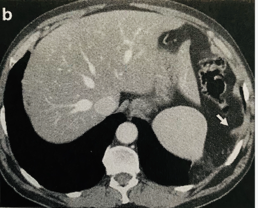 Dangling sign seen on CT scan where the free edge of the torn diaphragm curls inward away from the thoracoabdominal wall.