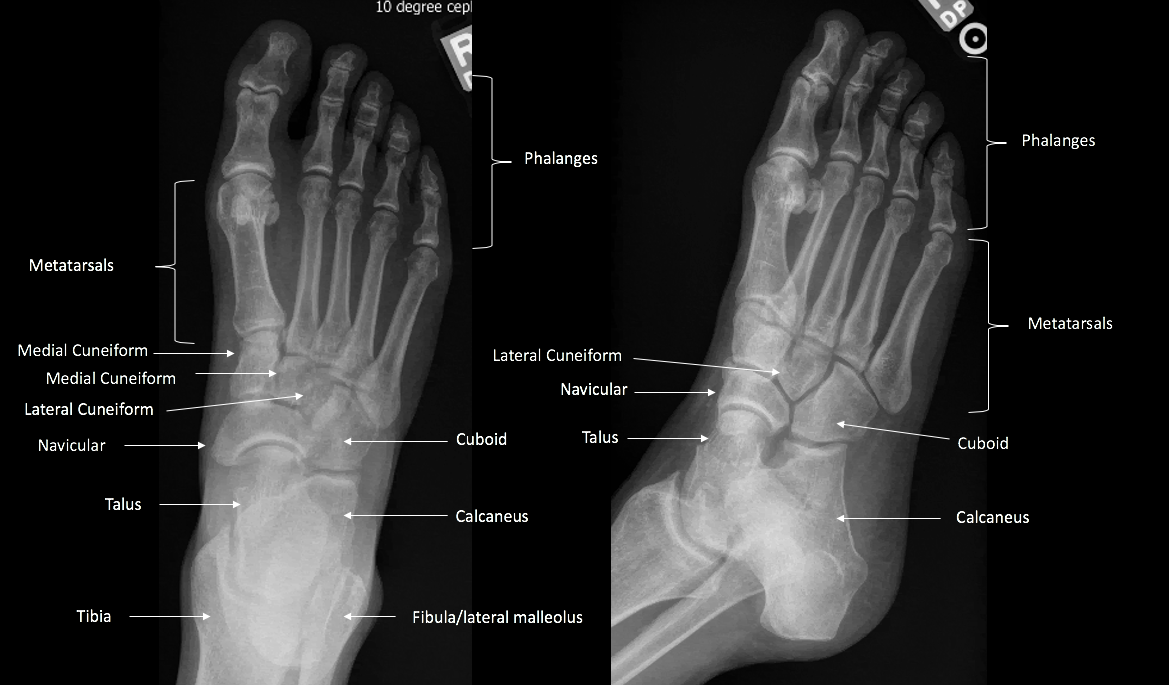 AP and Oblique views of the foot