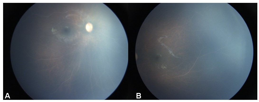 Figure 1 : Fundus photo of right eye ( Figure 1, A ) and left eye ( Figure 2, B ) of a 15 month old male child showing whitish creamy retinal vessels suggestive of lipemia retinalis