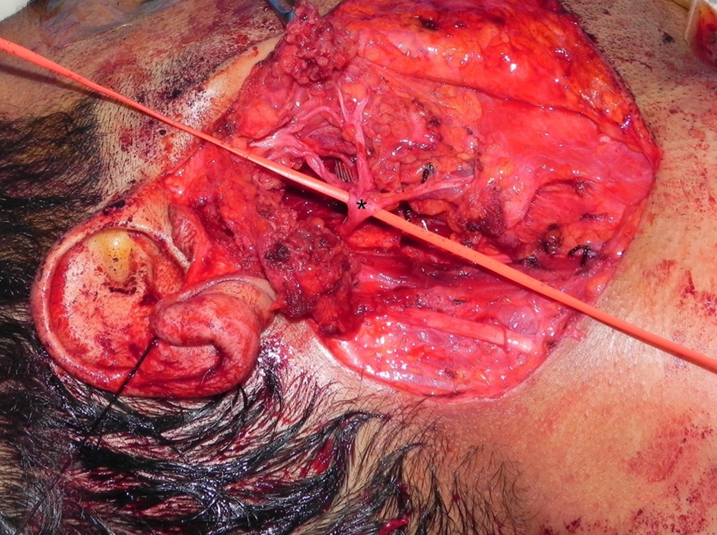 <p>Total Parotidectomy Visualized During Surgery