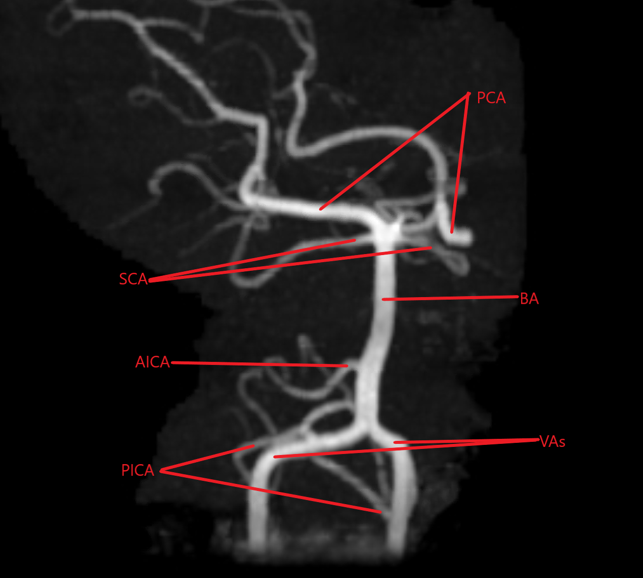 Magnetic Resonance Angiogram of the posterior circulation