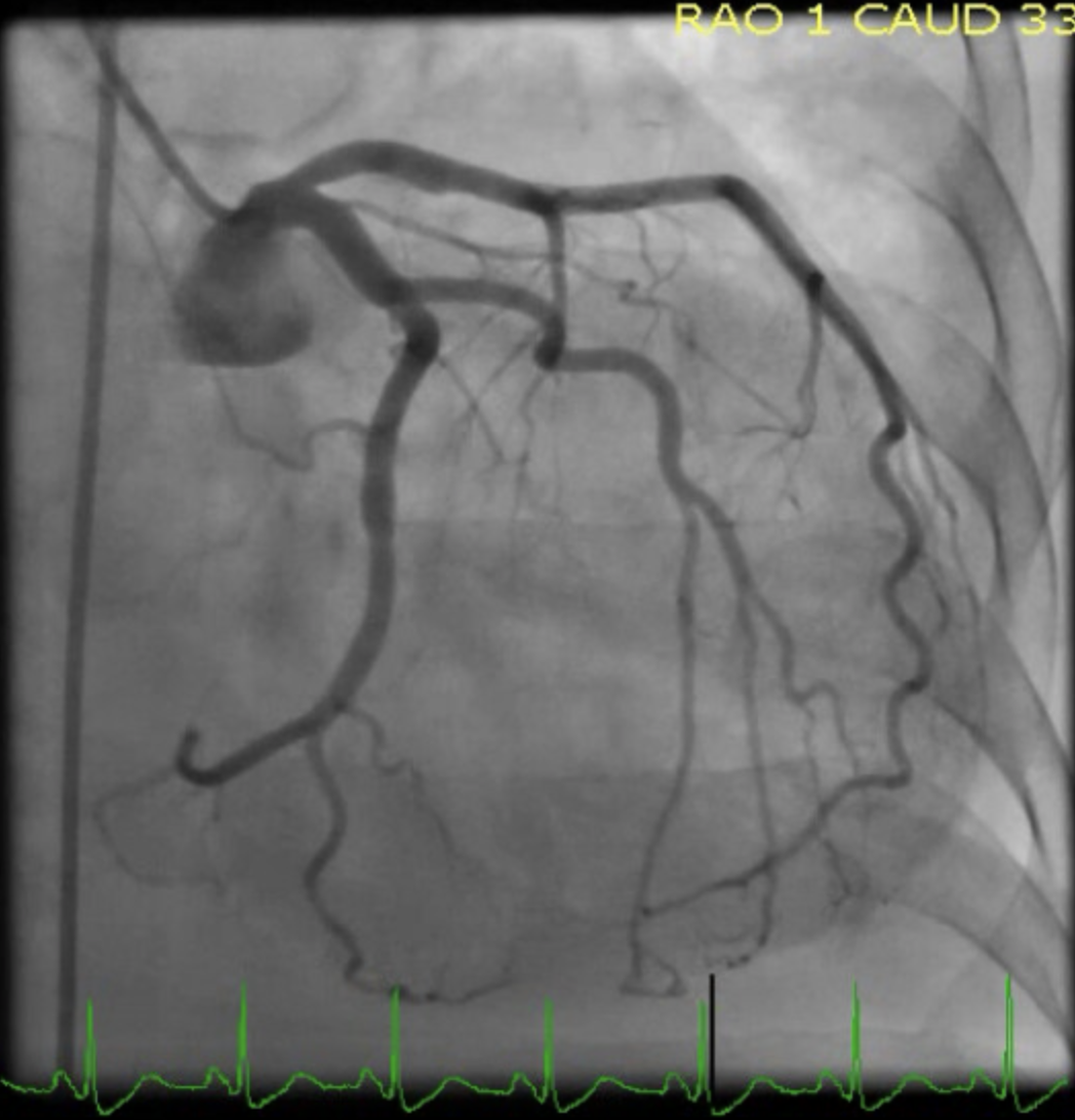Mid-Ventricular Cardiomyopathy

Left Heart Catheterization showing normal coronaries in the patient with shown transthoracic echocardiographic findings