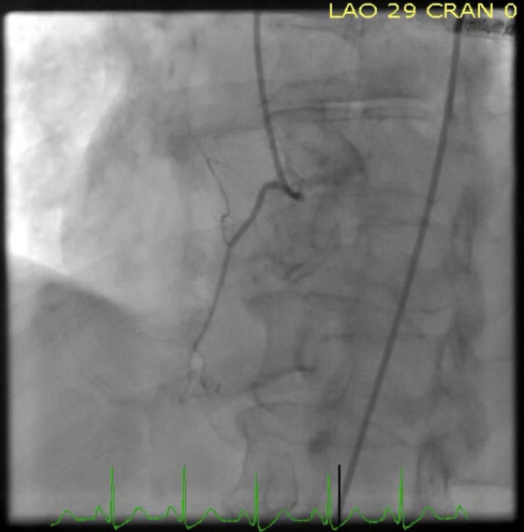 Mid-Ventricular Cardiomyopathy

Left Heart Catheterization showing normal coronaries in the patient with shown transthoracic echocardiographic findings