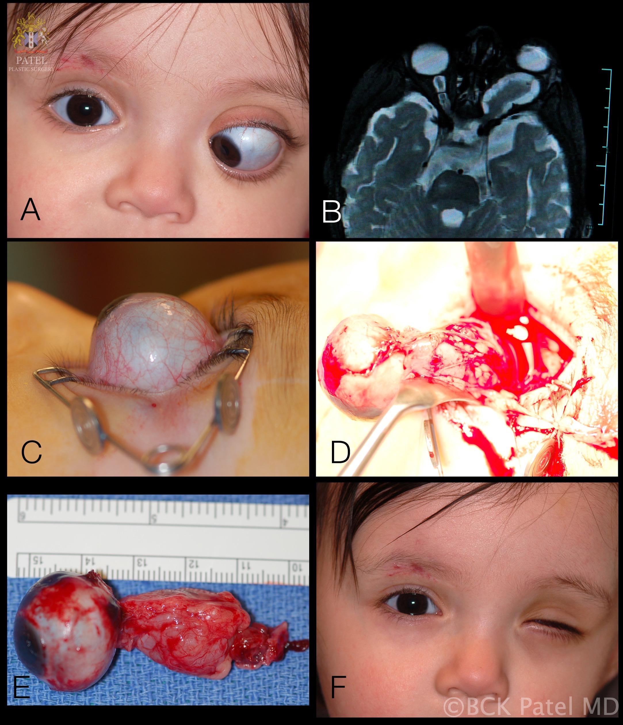 <p>Left Optic Nerve Glioma in Toddler