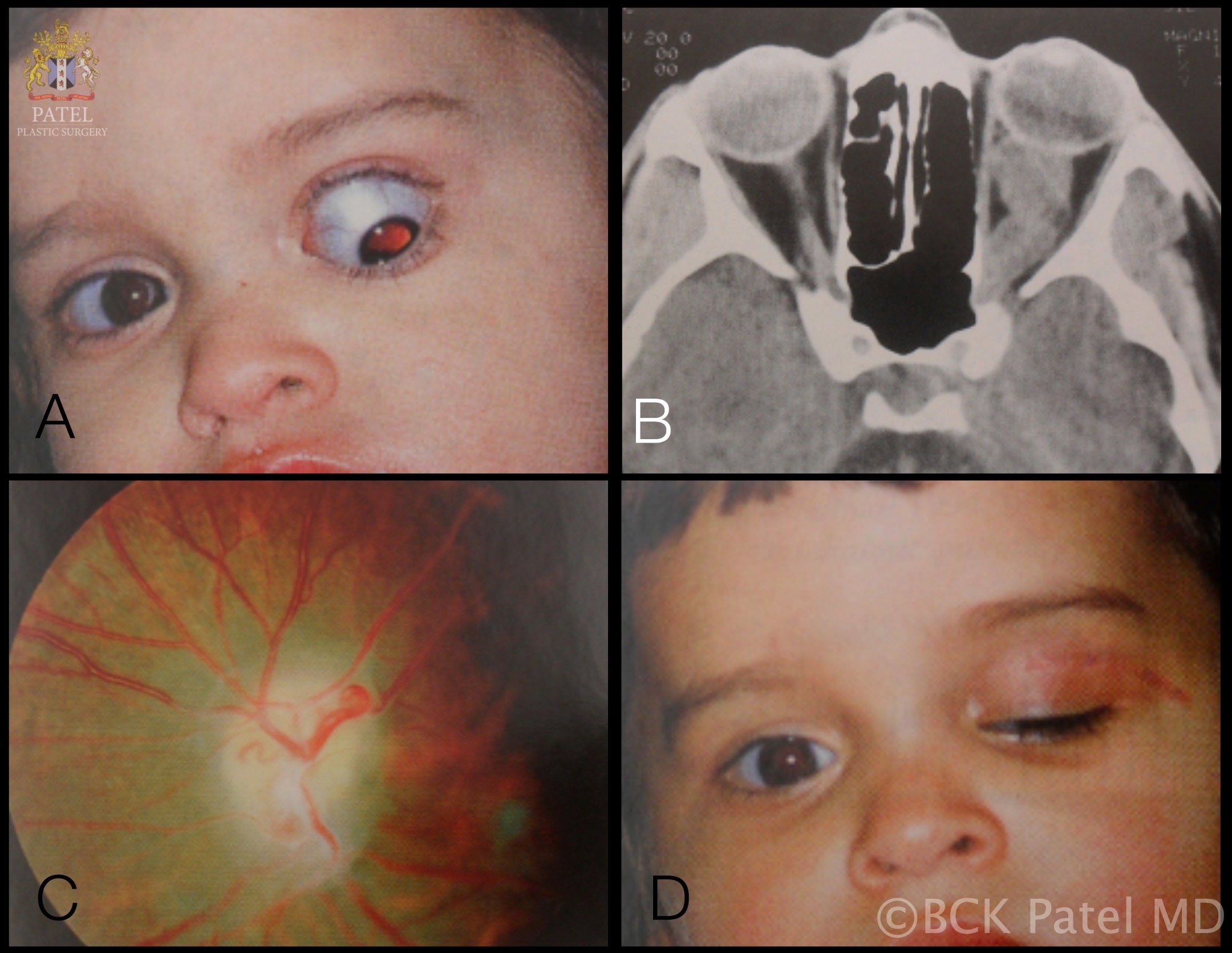 <p>Optic Nerve Glioma in a Boy