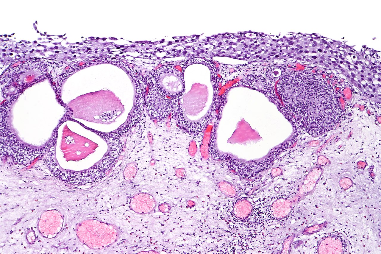 <p>Urothelial Carcinoma In Situ in the Setting of Cystitis Cystica et Glandularis</p>
