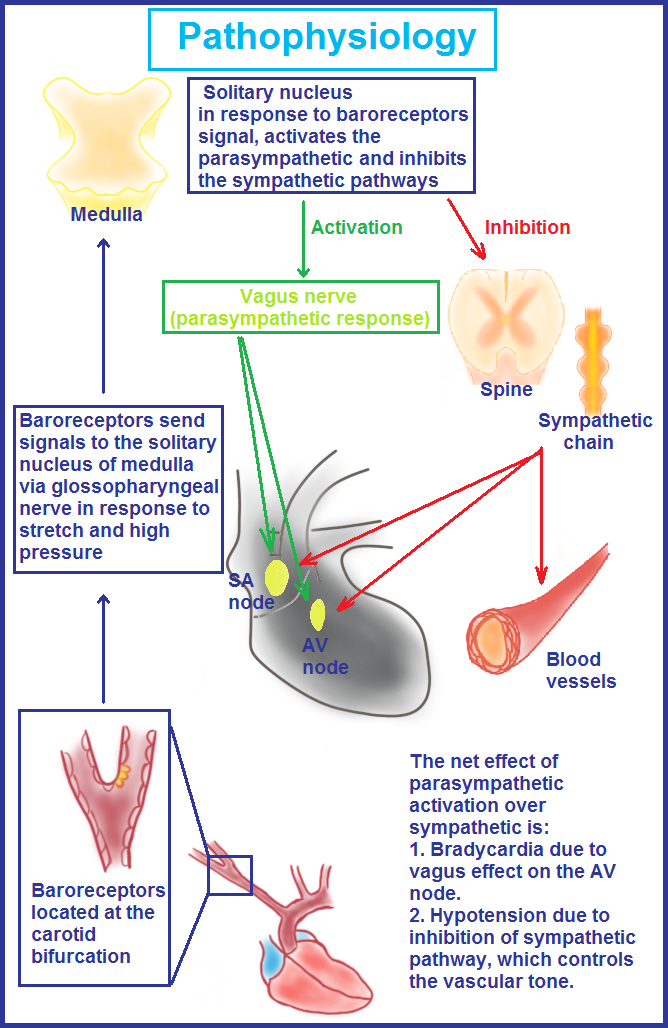 <p>Pathophysiology of Carotid Hypersensitivity Syndrome</p>
