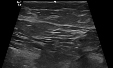 Sonographic cross-sectional view of benign breast tissue with typical hyperechoic, hypoechoic layers of skin, fat, fibroglandular and muscle