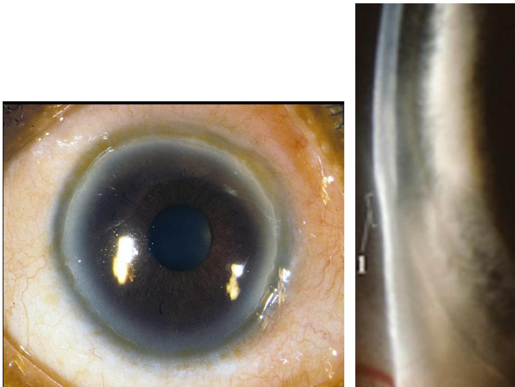 Figure 1: The images are showing peripheral corneal thinning on slit lamp examination in a patient with Furrow Degeneration.