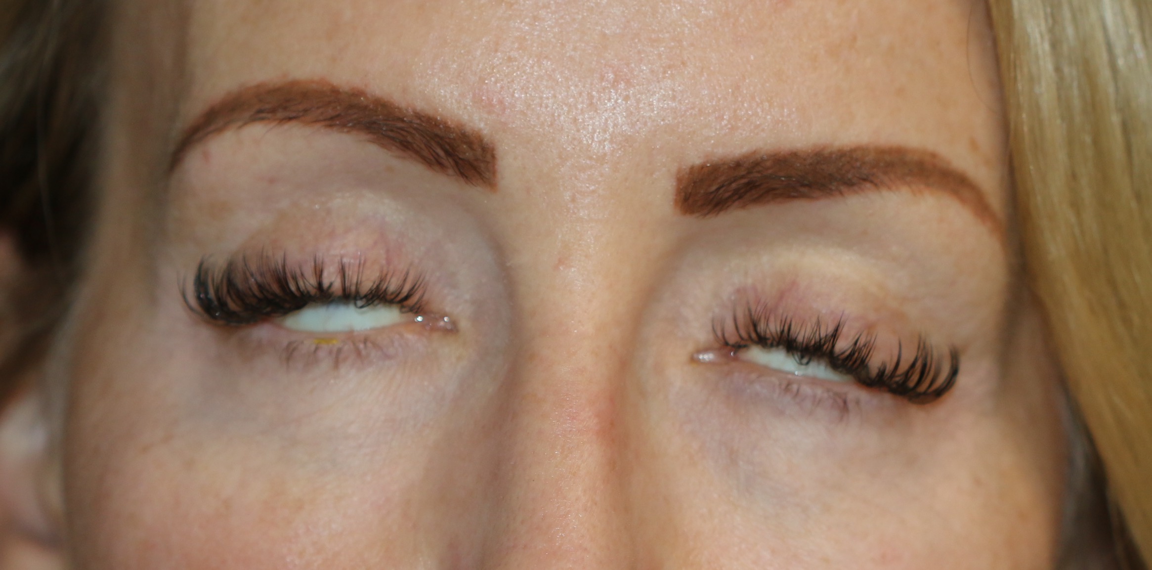 Bilateral lagophthalmos one year after upper blepharoplasty Right lagophthalmos measures 2