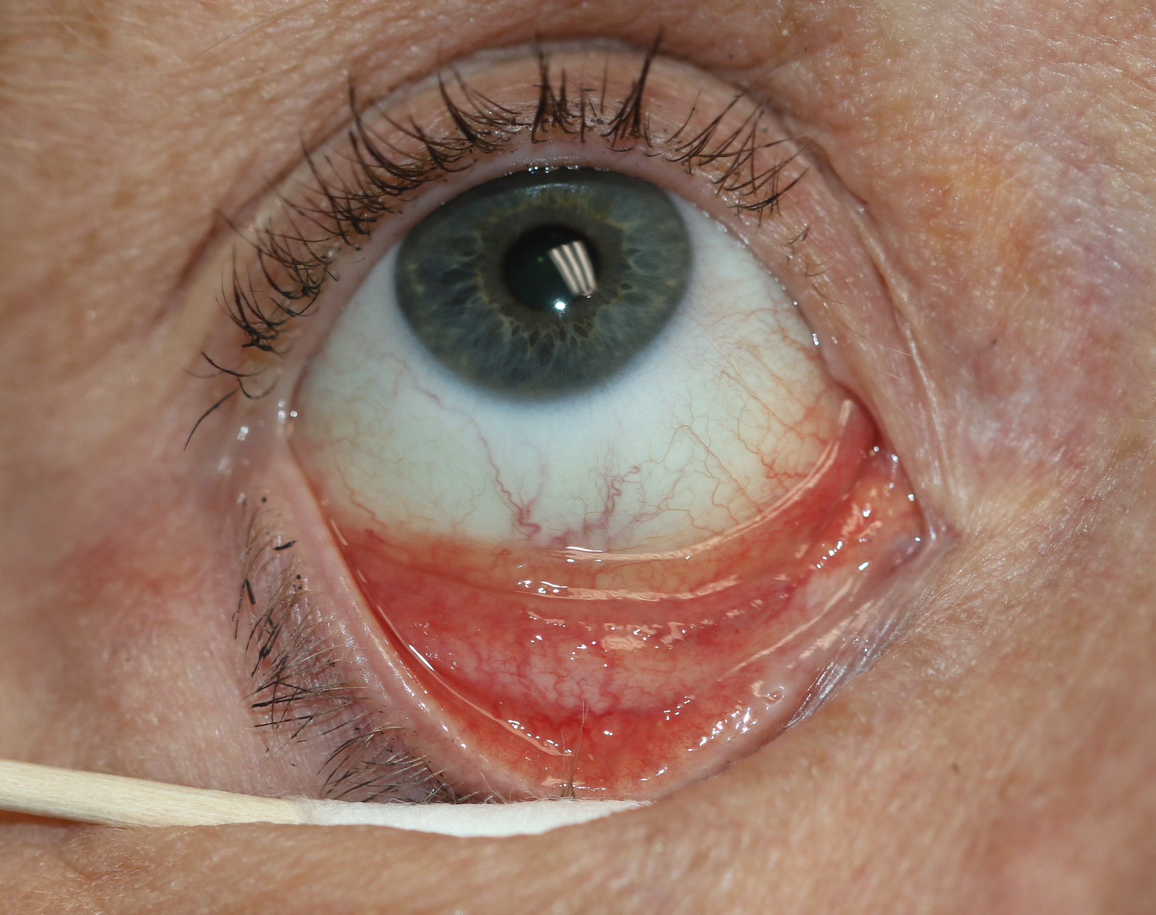 Follicular conjunctivitis may be seen with viral infections like herpes zoster, Epstein-Barr virus infection, infectious mononucleosis), chlamydial infections, and in reaction of topical medications and molluscum contagiosum