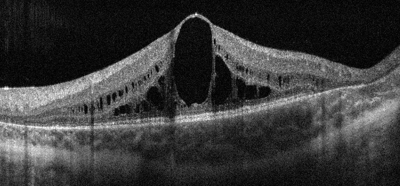 Optical coherence tomography of the macula showing intraretinal cystic spaces in a 12-year-old boy with gyrate atrophy of the choroid and retina