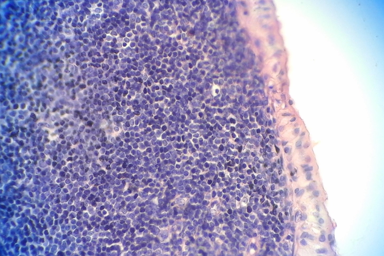 Figure 3:
Photomicrograph showing a bilayered eosinophilic oncocytic epithelium lining the cyst lumen with lymphoid aggregates in the stroma, (Hematoxylin and eosin, x 400)