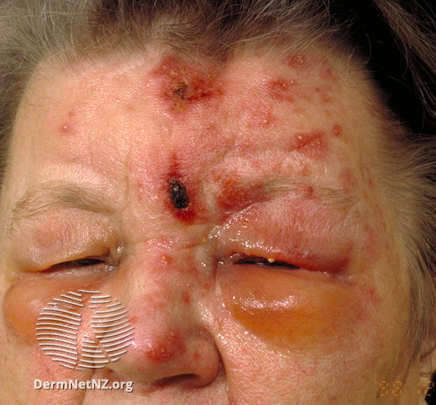 <p>Herpes Zoster Ophthalmicus With Hutchinson Sign
