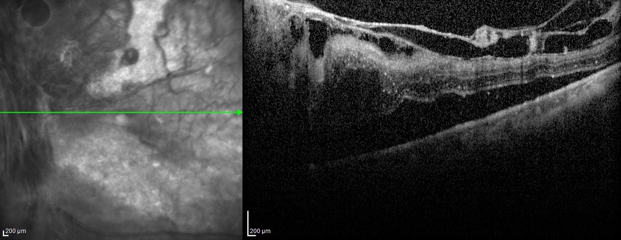Optical coherence tomography (OCT) scan of macula of the left eye showing macular traction retinal detachment due to prolifer