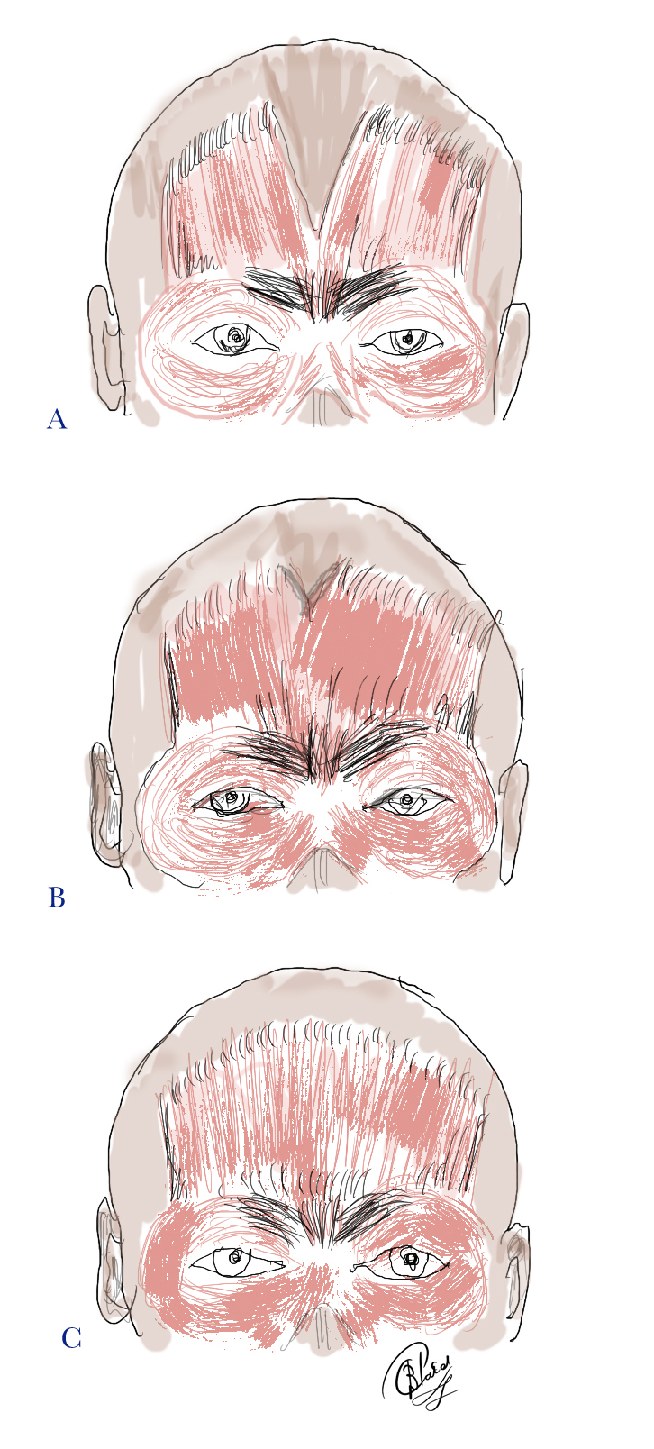 The Fronatalis Muscle: Bifurcation of the frontalis muscle may be 
A