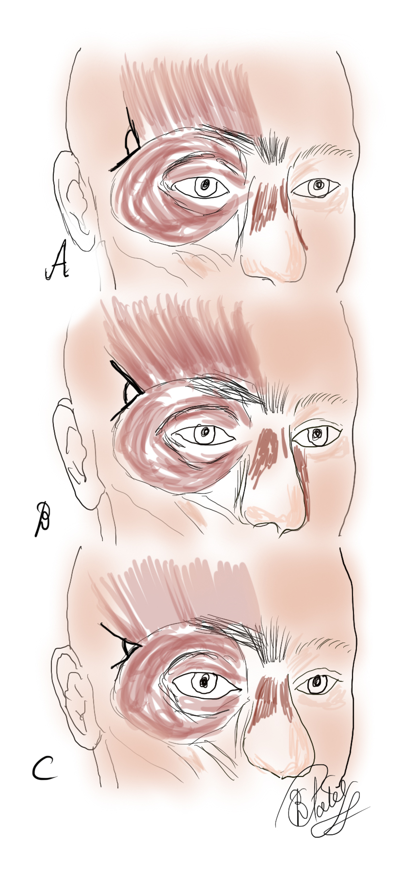 The Frontalis Muscle: The angle of insertion of the frontalis muscle laterally as measured against the orbital orbicularis oculi varies:
A