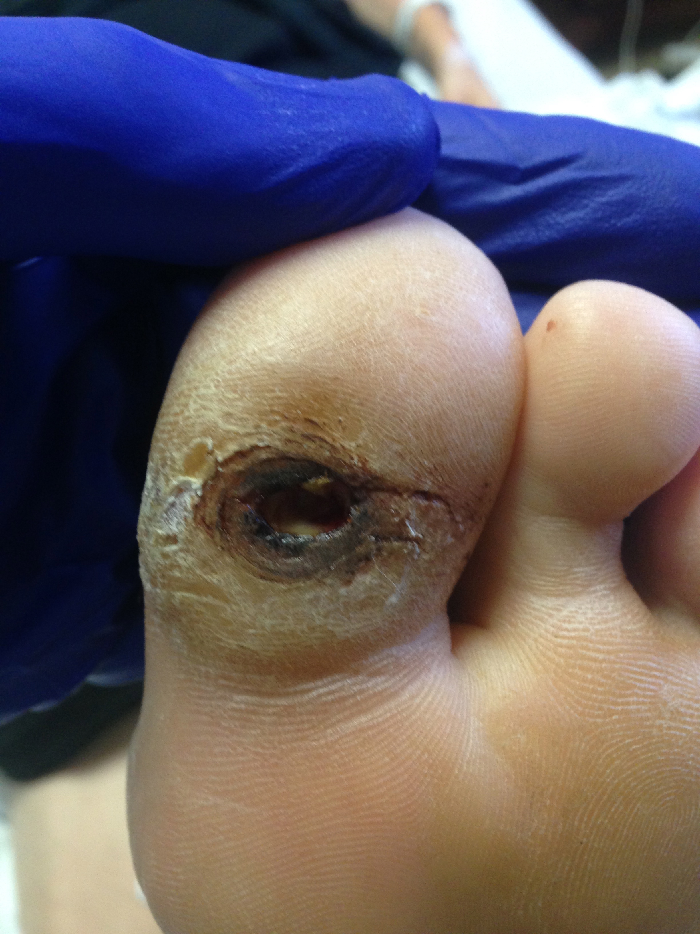 <p>Neuropathic Ulcer. Neuropathic Ulcer beneath the great toe in a patient with diabetes and peripheral neuropathy.</p>