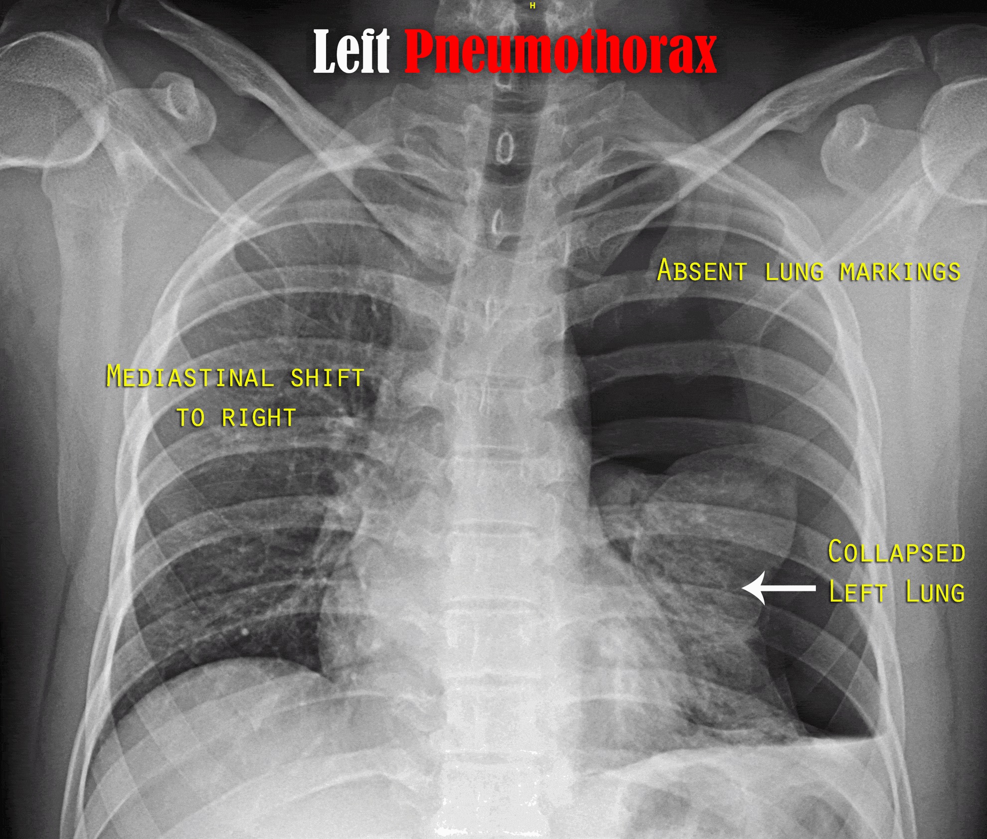 <p>Left-Sided Tension Pneumothorax Radiograph