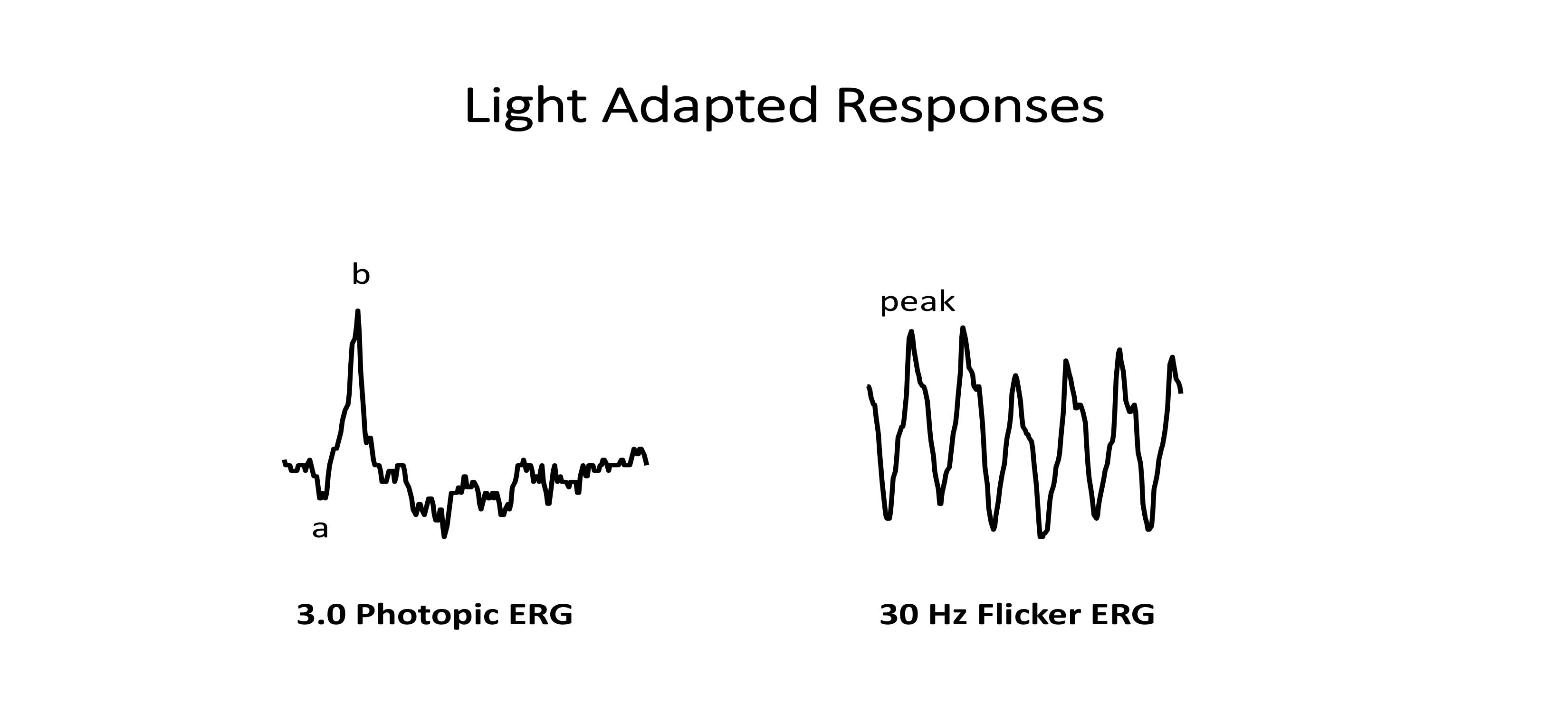 Illustration of a normal cone driven light adapted ERG response (3.0 Photopic ERG) and a normal 30 hz flicker ERG response
