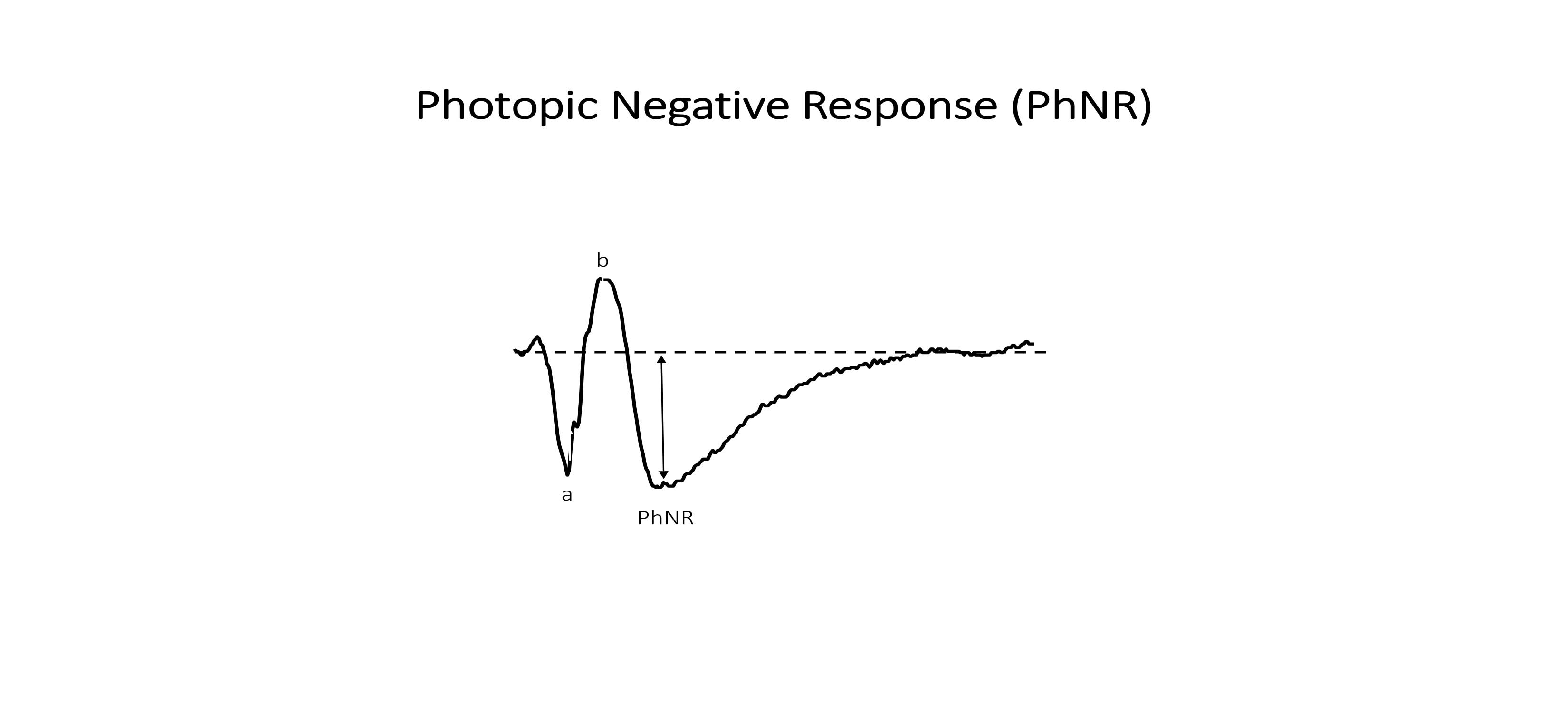 Illustration of a normal photopic negative response ERG recording