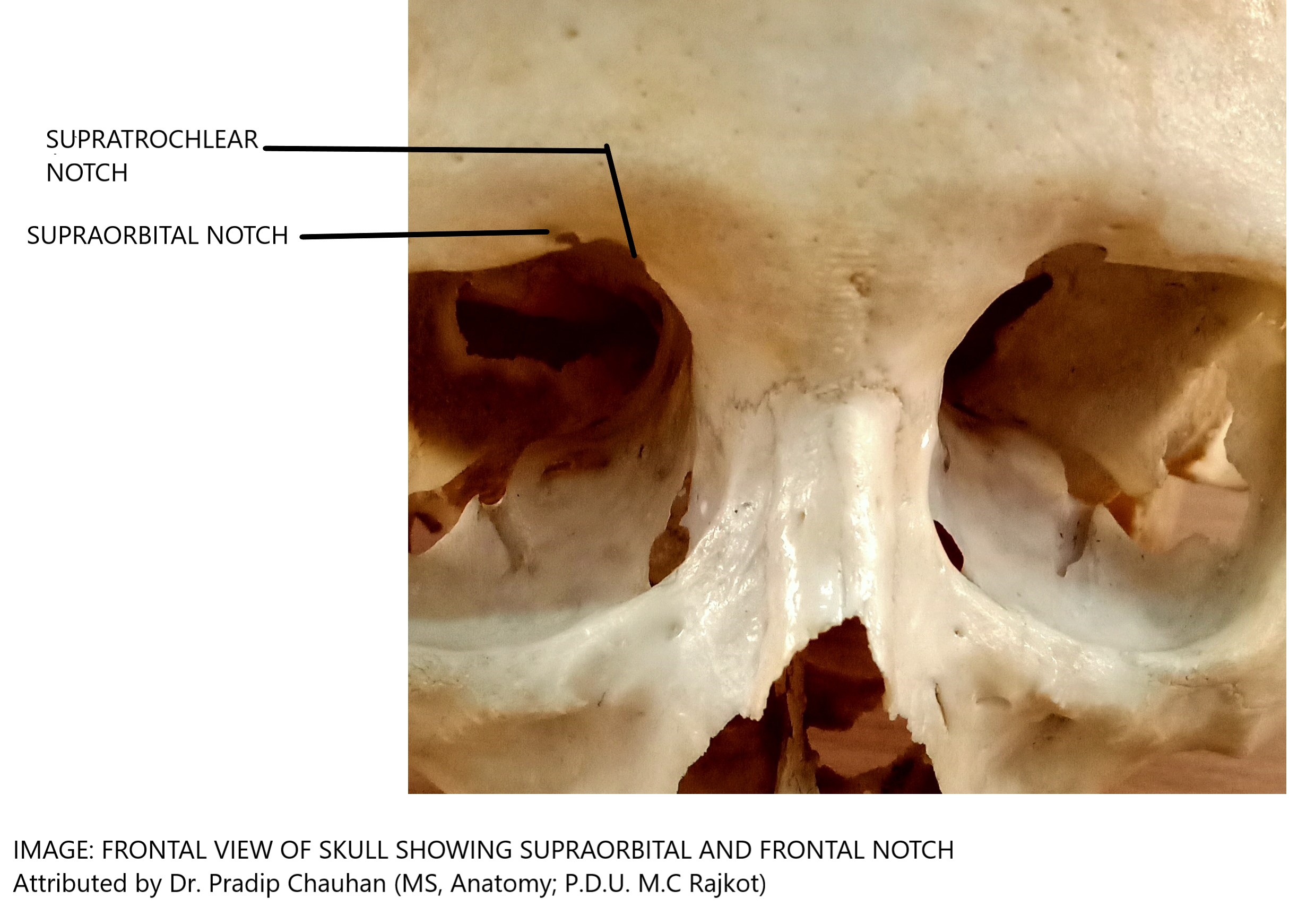 <p>Supratrochlear and Supraorbital Notches