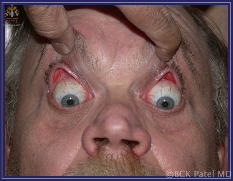 The Floppy Eyelid Syndrome: Excessive laxity of upper and lower eyelids seen with weight gain and weight loss