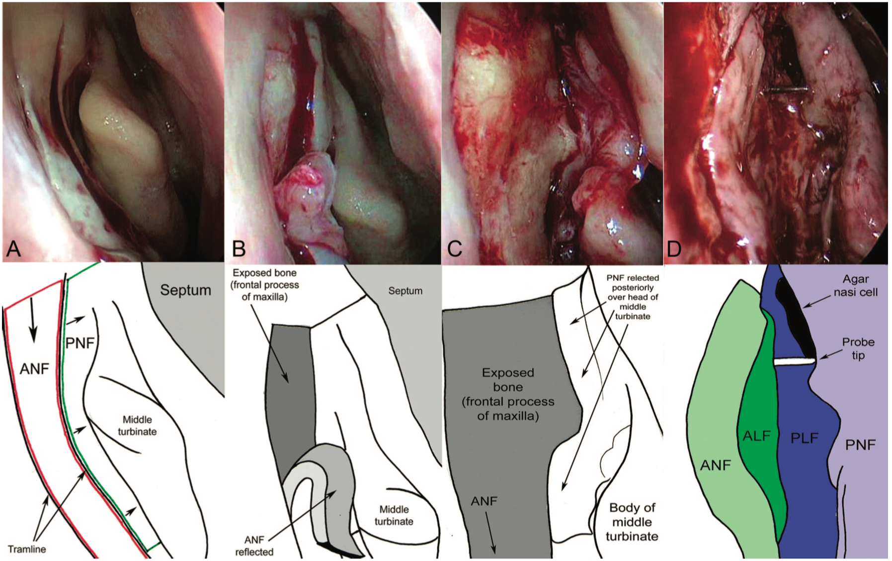 Creation of Mucosal Flaps in an Endoscopic Dacryocytorhinostomy: The right nasal cavity