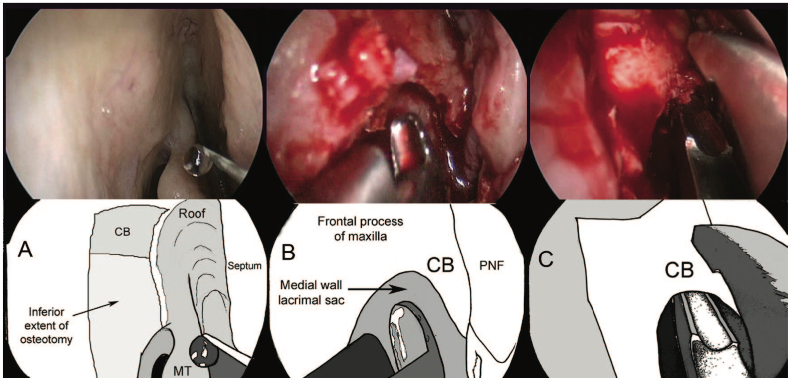 Bony Osteotomy in an Endoscopic Dacryocystorhinostomy: A, The right lateral nasal wall prior to surgery with a schematic illustration showing the underlying position of the osteot-
omy