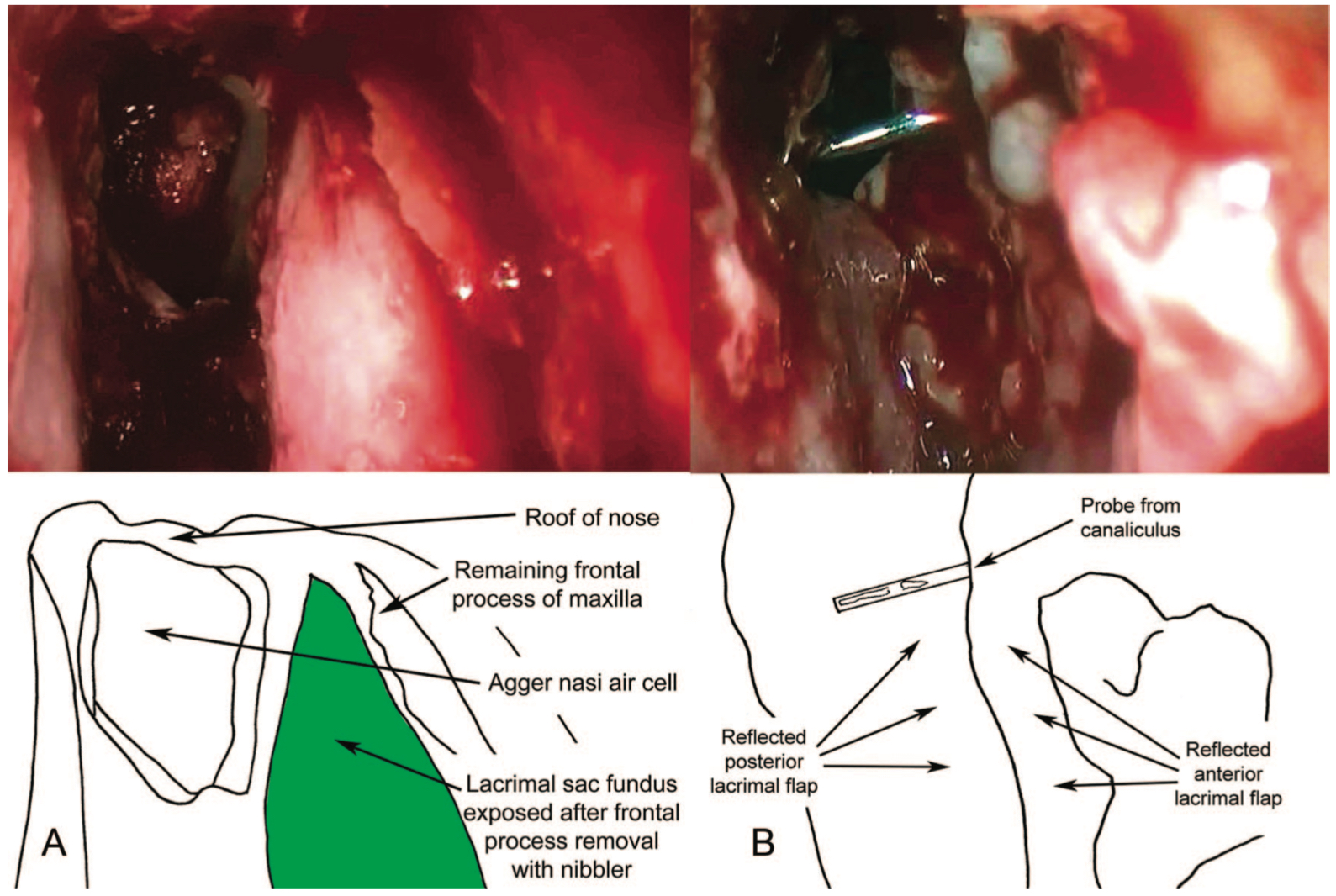 Endoscopic Dacryocystorhinostomy: A view of the lateral wall of the left nasal cavity showing full exposure of the lacrimal sac (A) and marsupialization of the lacrimal sac (B)
