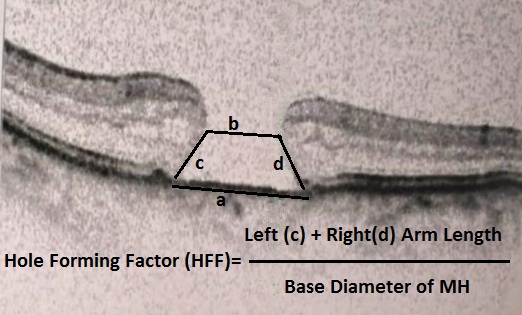SD-OCT (macular scan) of FTMH showing Hole Forming Factor (HFF)