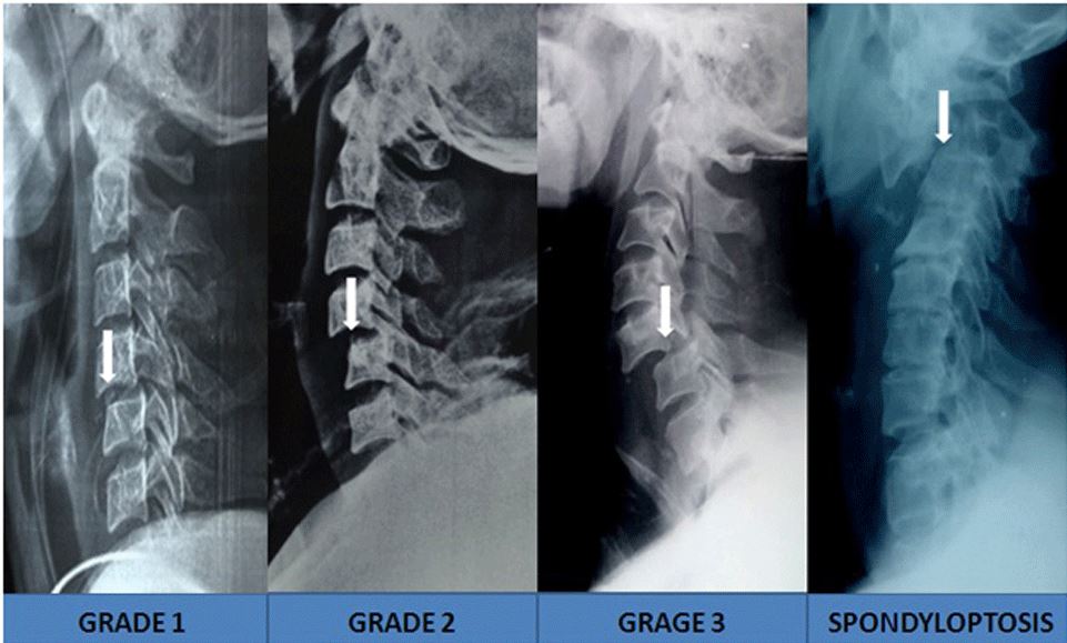 <p>Meyerding Subluxation Grading Applied to the Cervical Spine