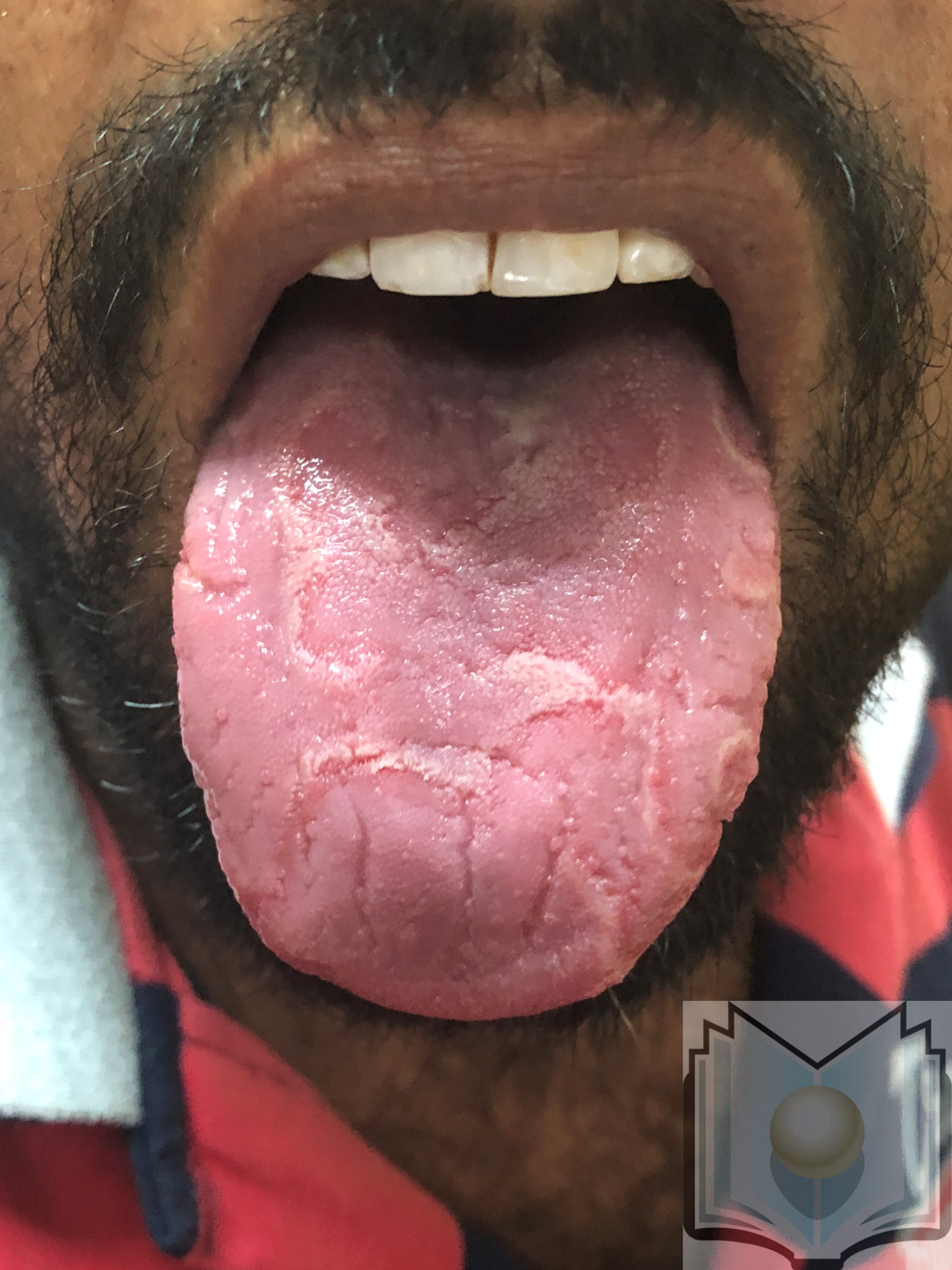 Geographic tongue 02
