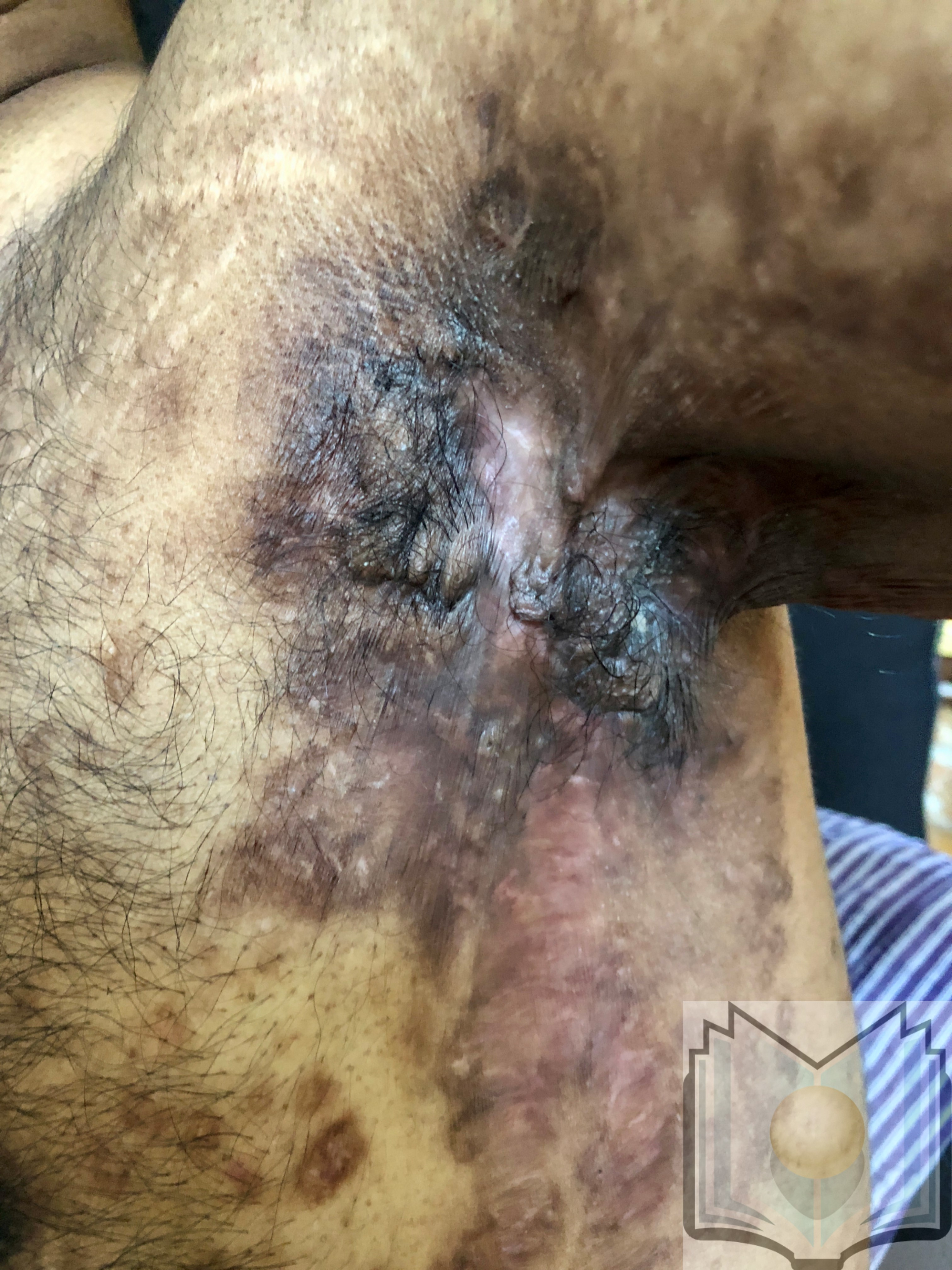 <p>Hidradenitis Suppurativa, Left Axilla. Multiple nodules and fibrotic scars are seen in the left axilla.</p>