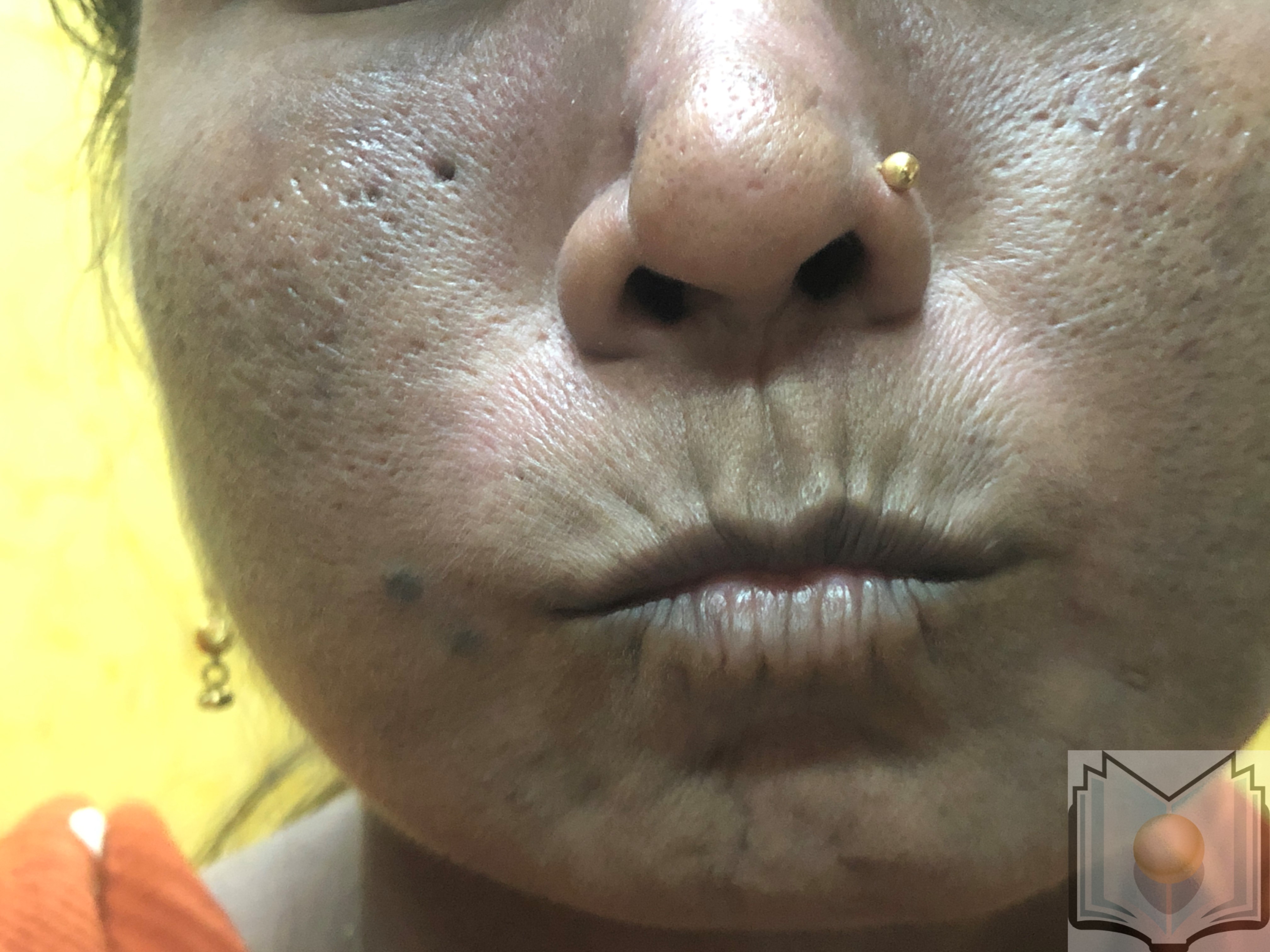 <p>Pursed Mouth in a Female Patient With Scleroderma