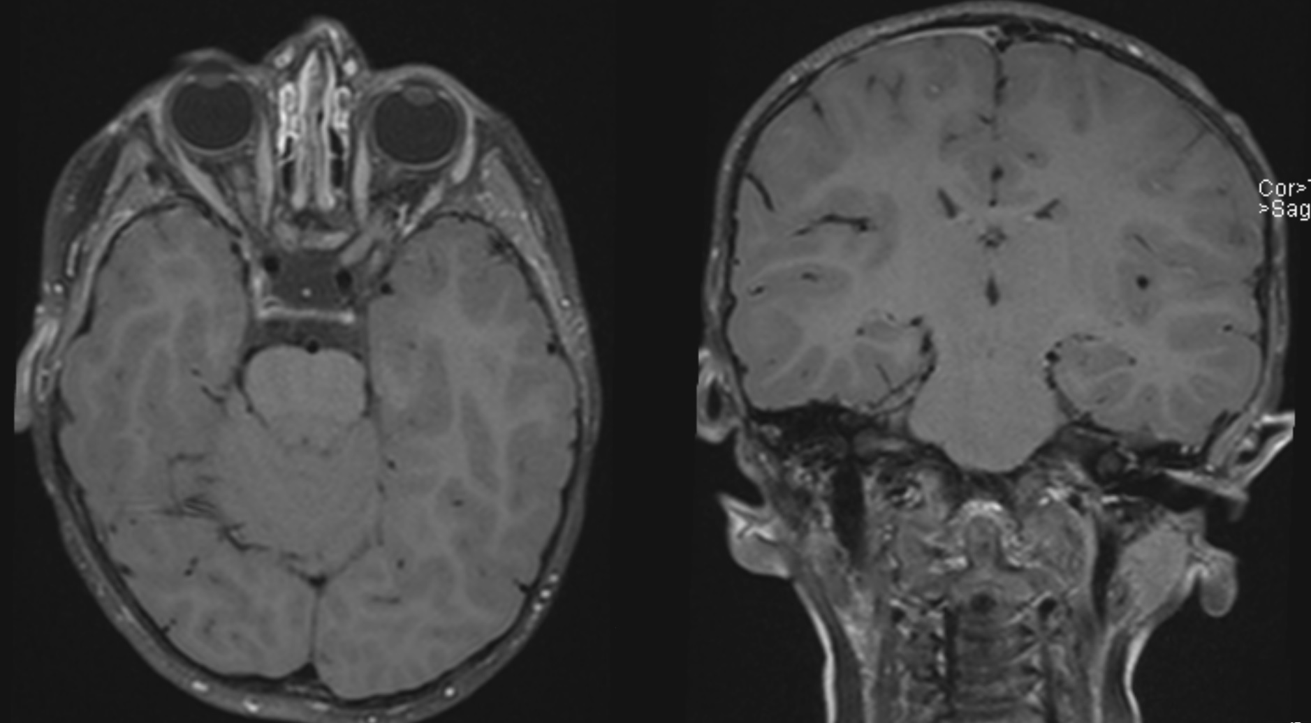 Axial and coronal post-contrast black blood images of the brain.