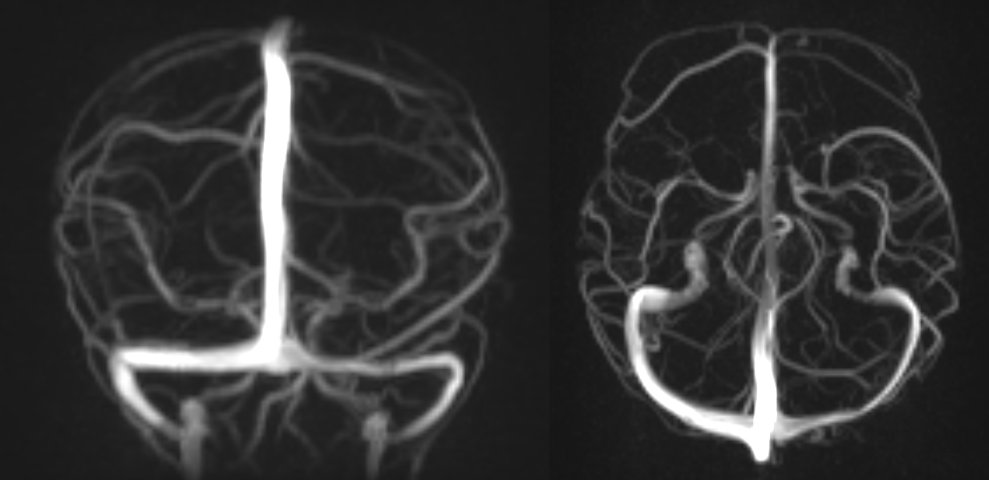 Coronal and axial "phase contrast" 3D reconstruction of cerebral venous system.