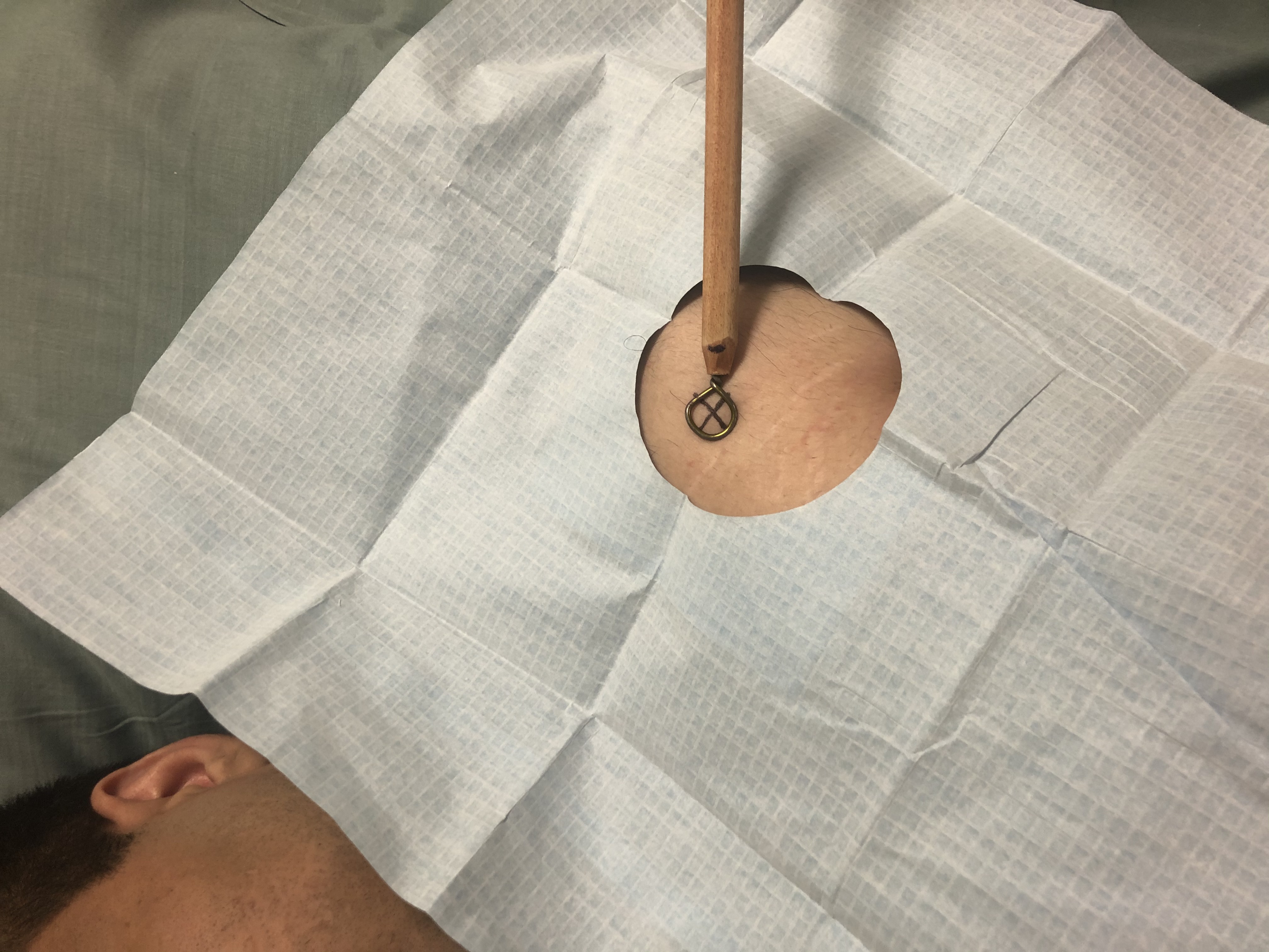 A metallic stick marker is used to assess the location of the skin immediately overlying the glenohumeral joint for a vertical/perpendicular needle approach for injection