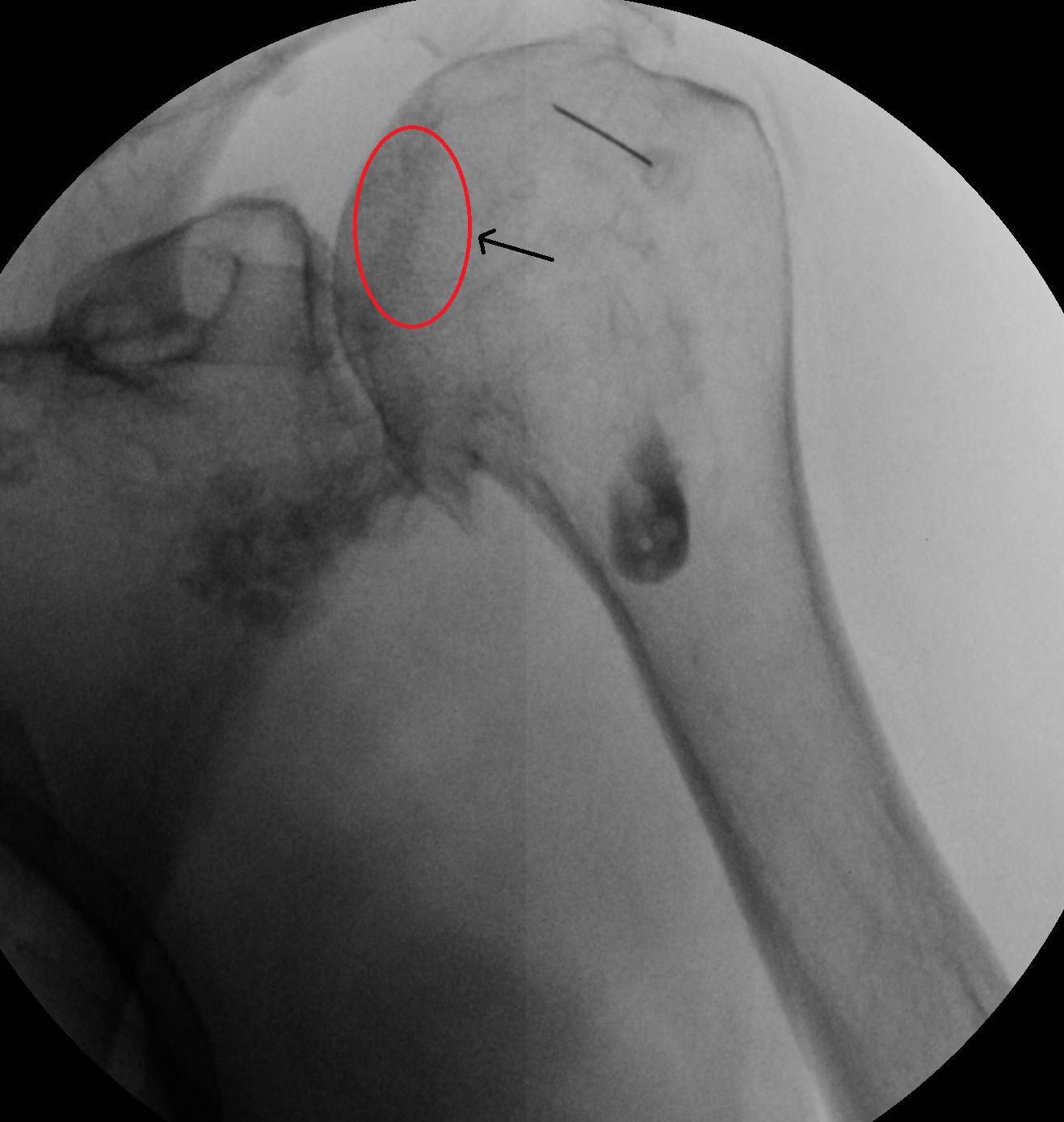A single fluoroscopic image demonstrates a malpositioned needle within the superior aspect of the humeral head