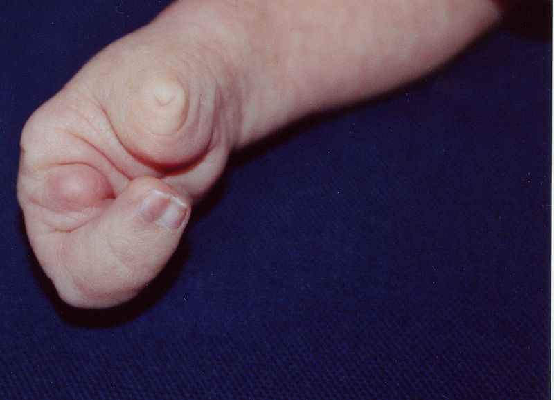 Ectrodactyly on a young child.