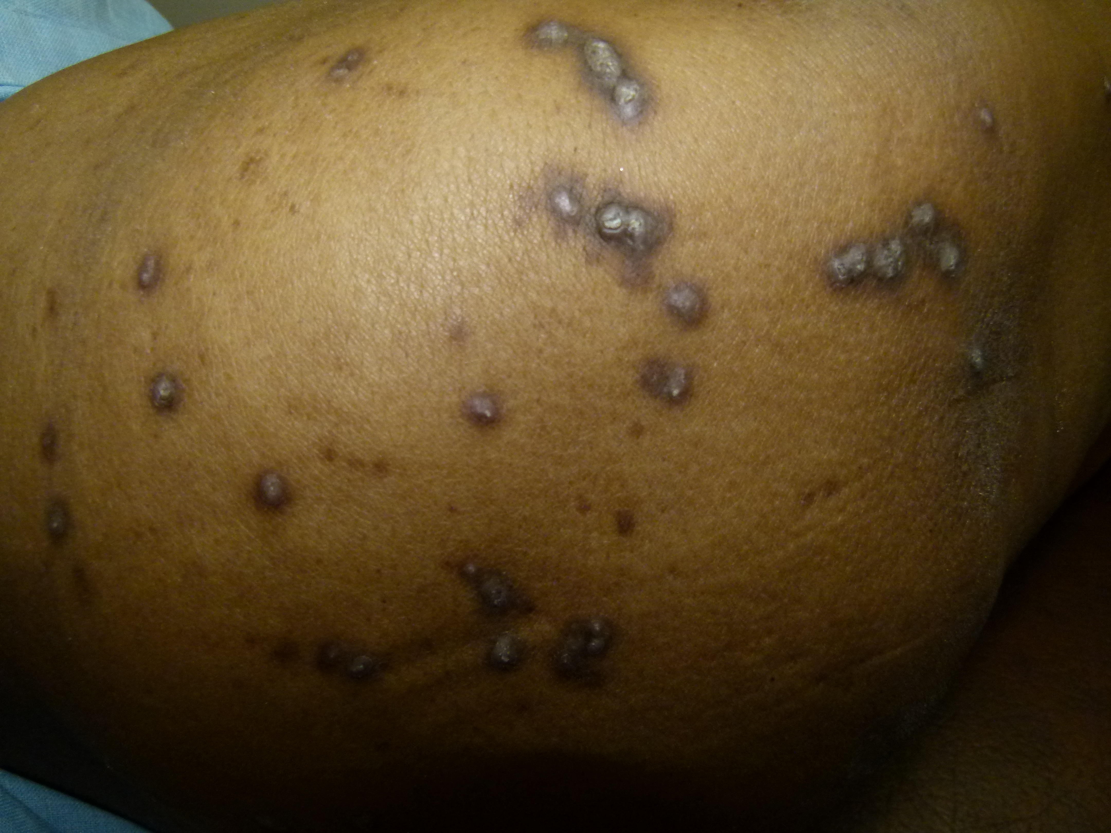 Acquired perforating disorder in a diabetic