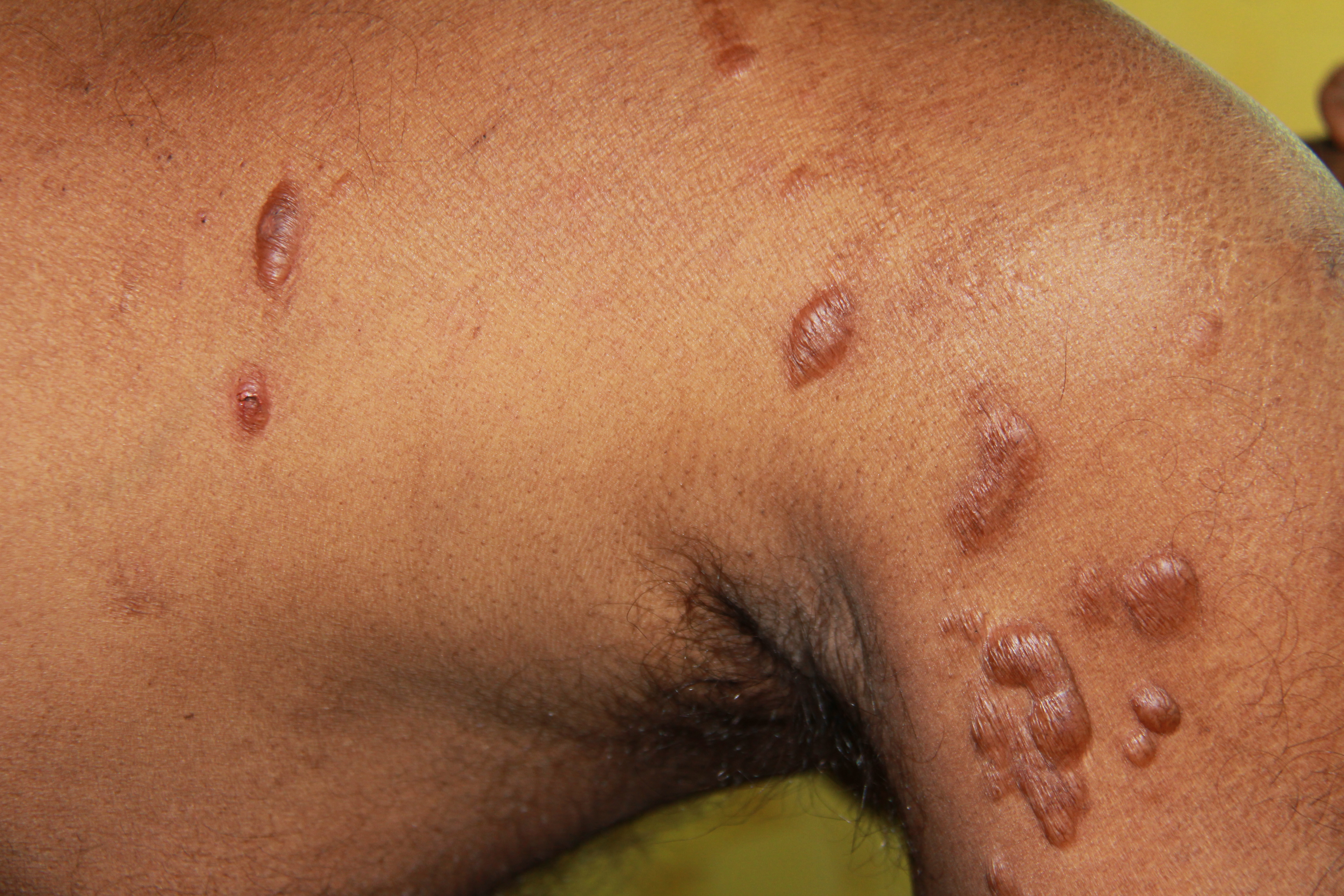 Histoid Leprosy