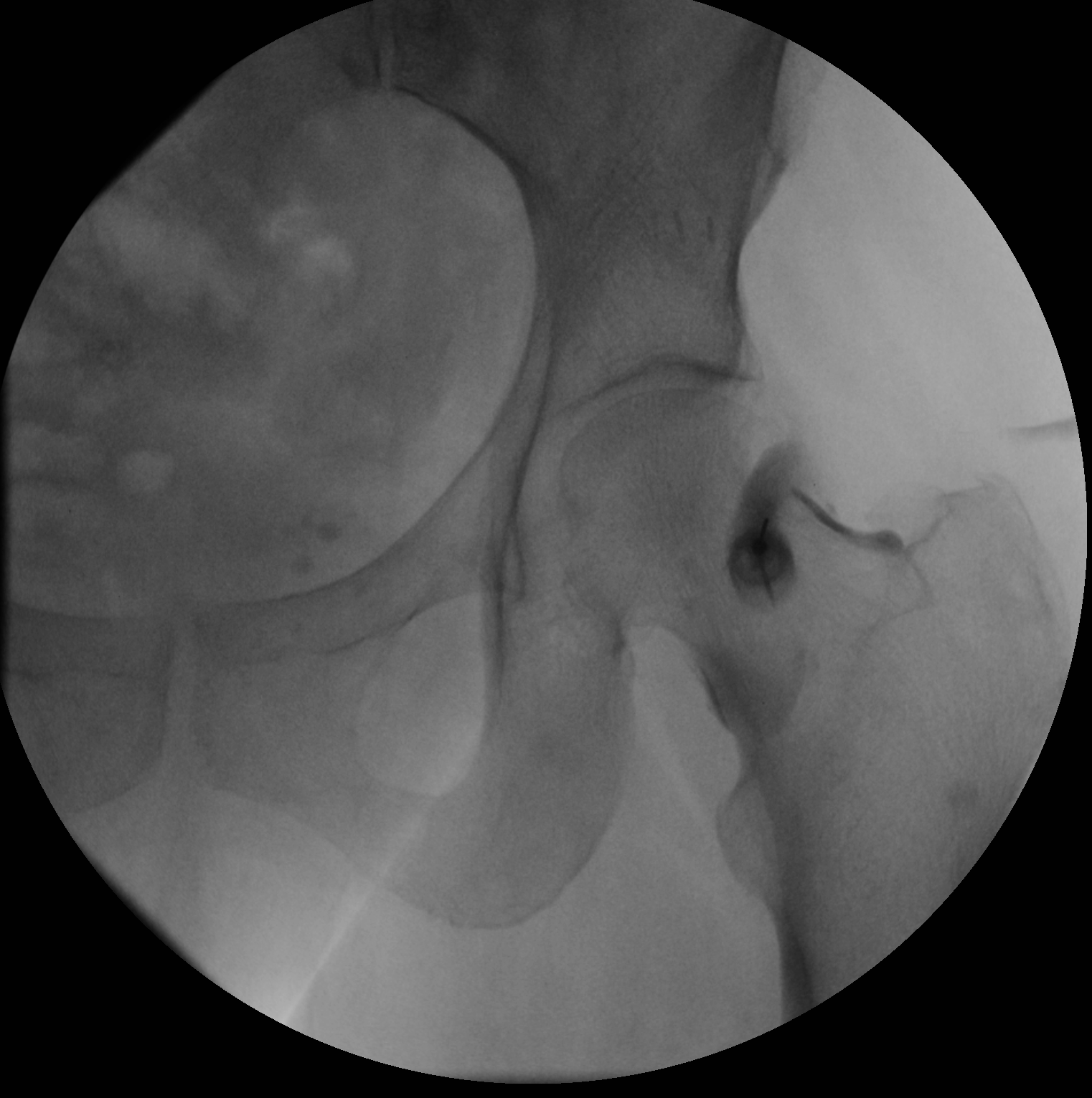 A small amount of iodinated contrast is injected into the femoroacetabular joint to ensure appropriate needle entry into the joint space