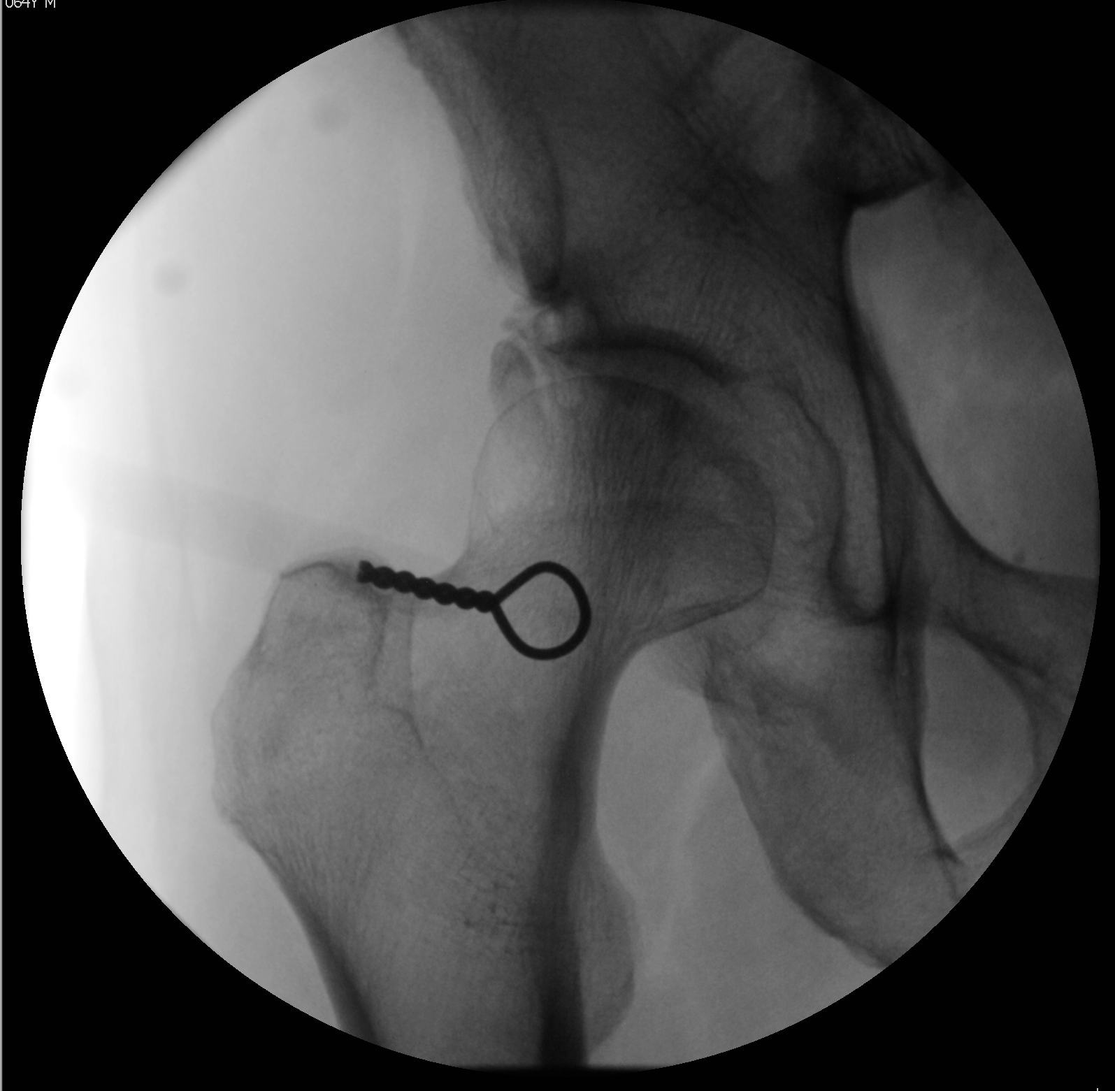 Initial fluoroscopic visualization of the hip joint