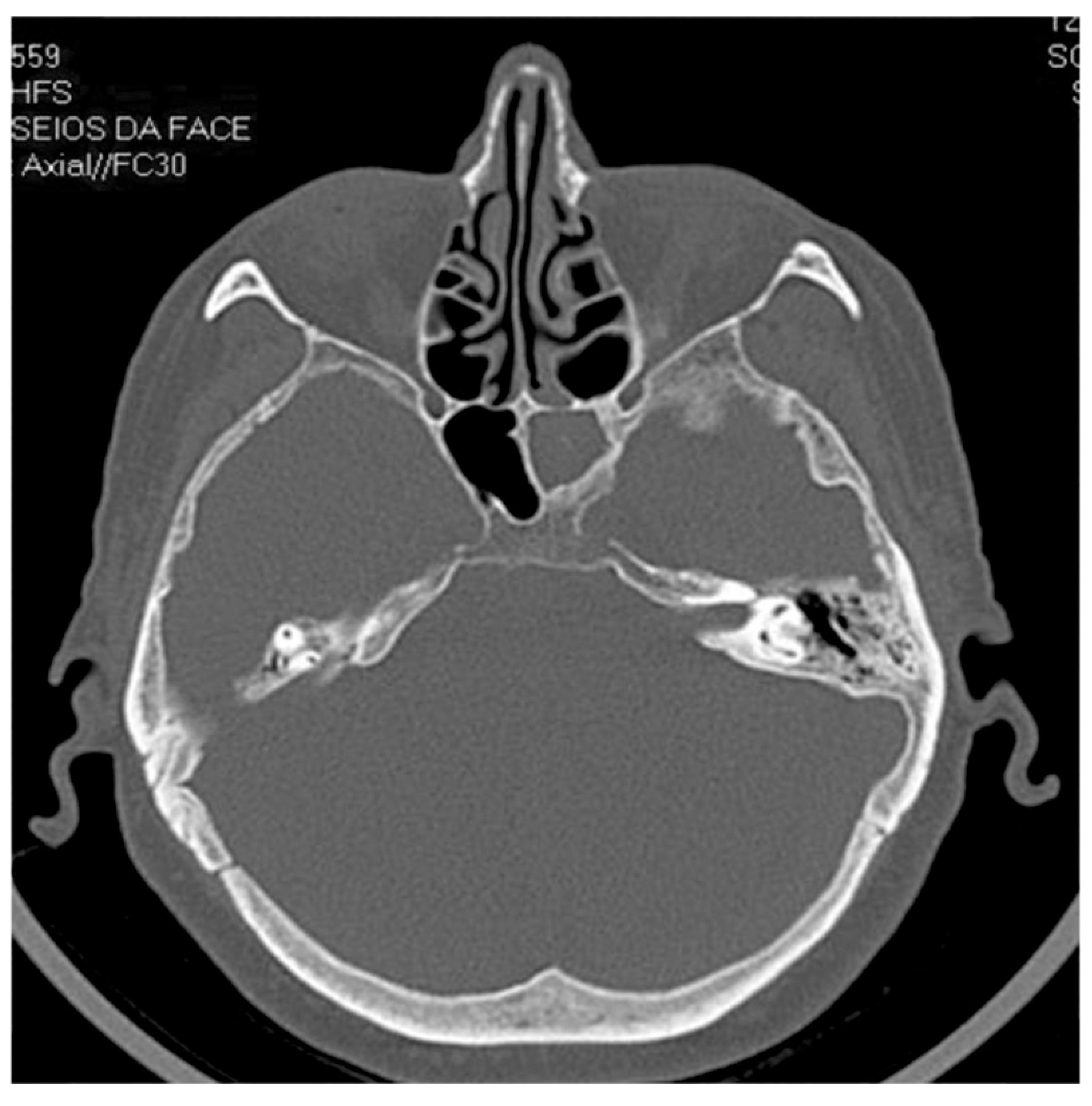 <p>Axial CT of Sphenoid Sinus