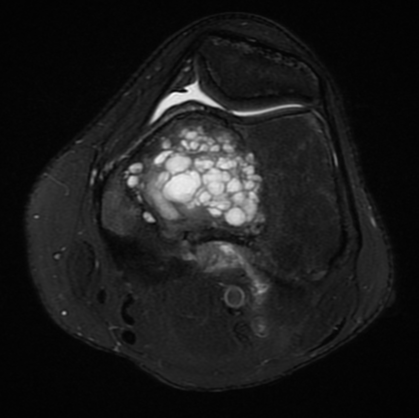 MRI image of an epiphyseal lesion.