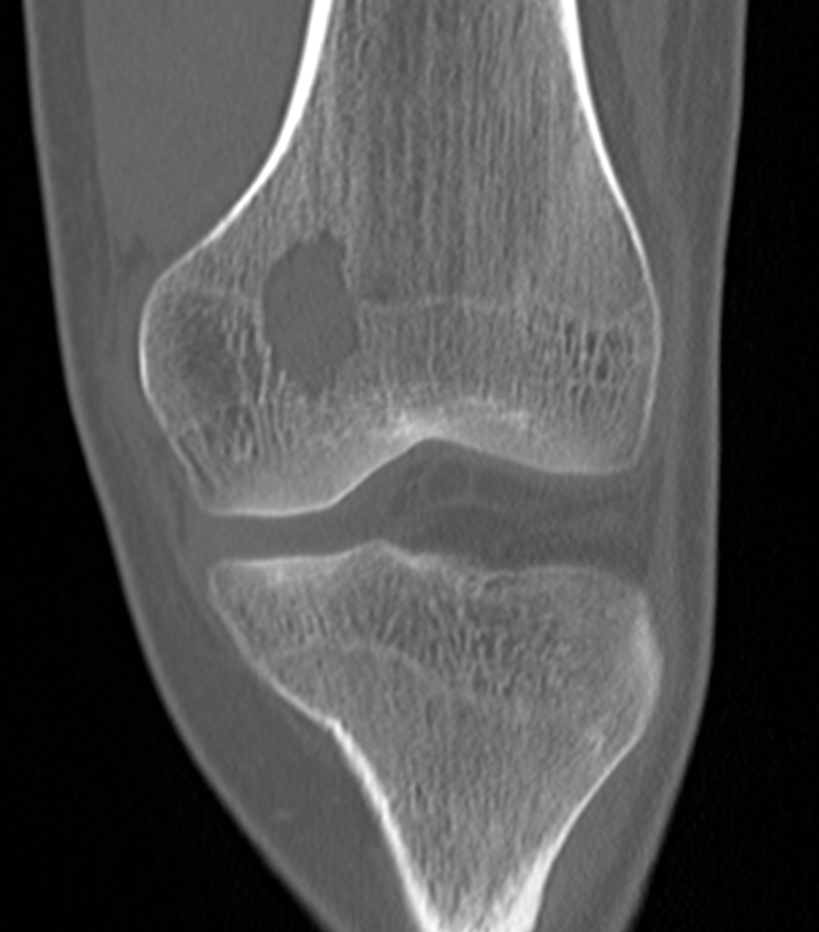Coronal CT demonstrates a lytic lesion within the physis/epiphysis of the distal femur.