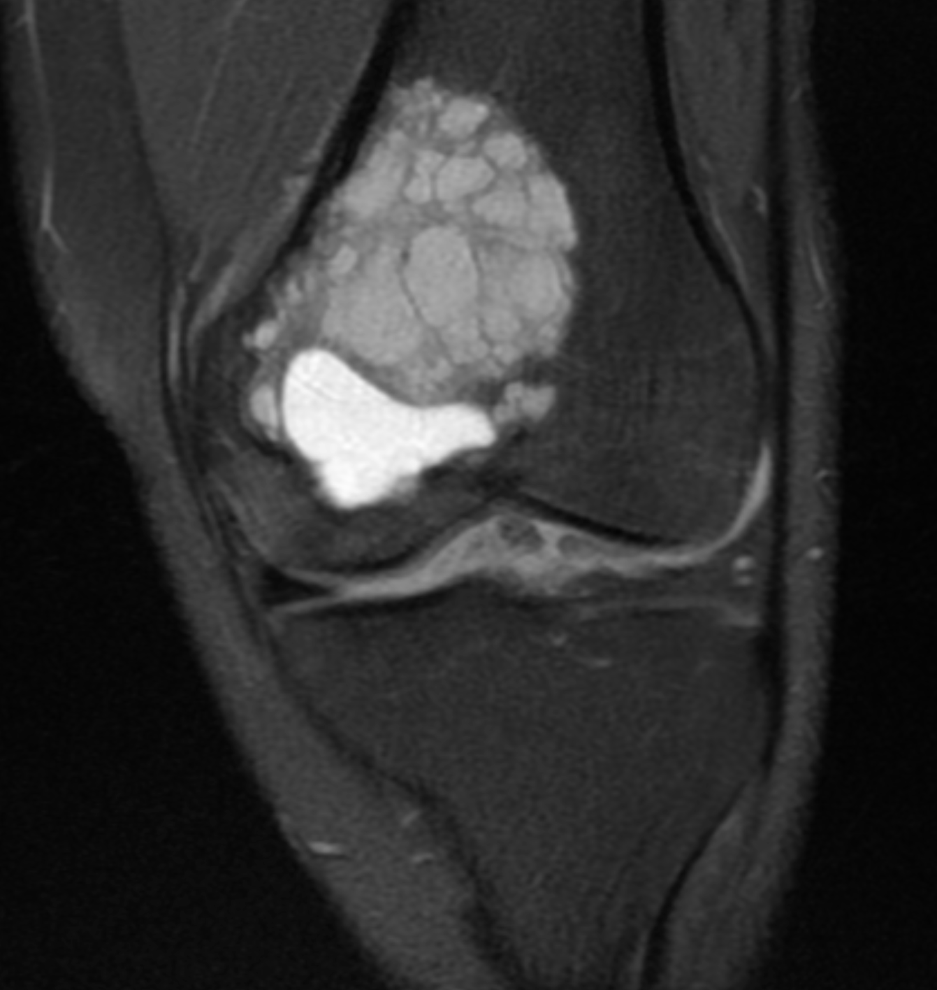 Coronal T2/STIR image of the left knee.